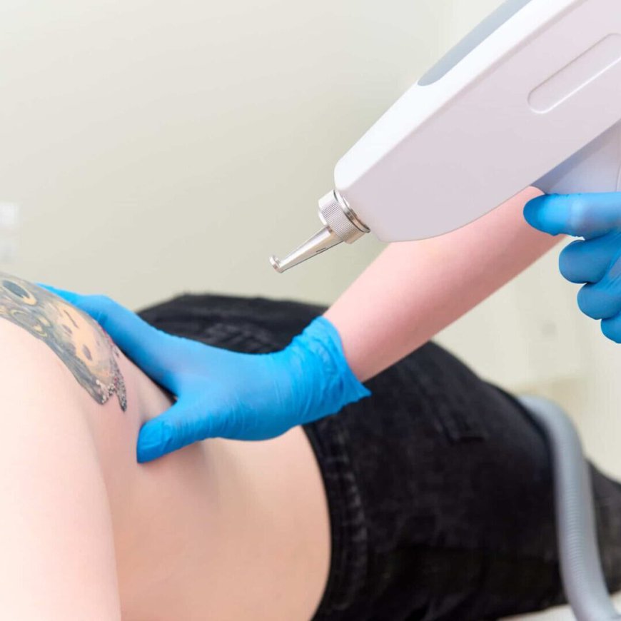 Laser Tattoo Removal: Start a New Chapter