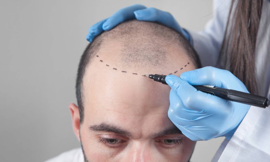 Get Scar-Free Hair Transplant for a Perfect Look