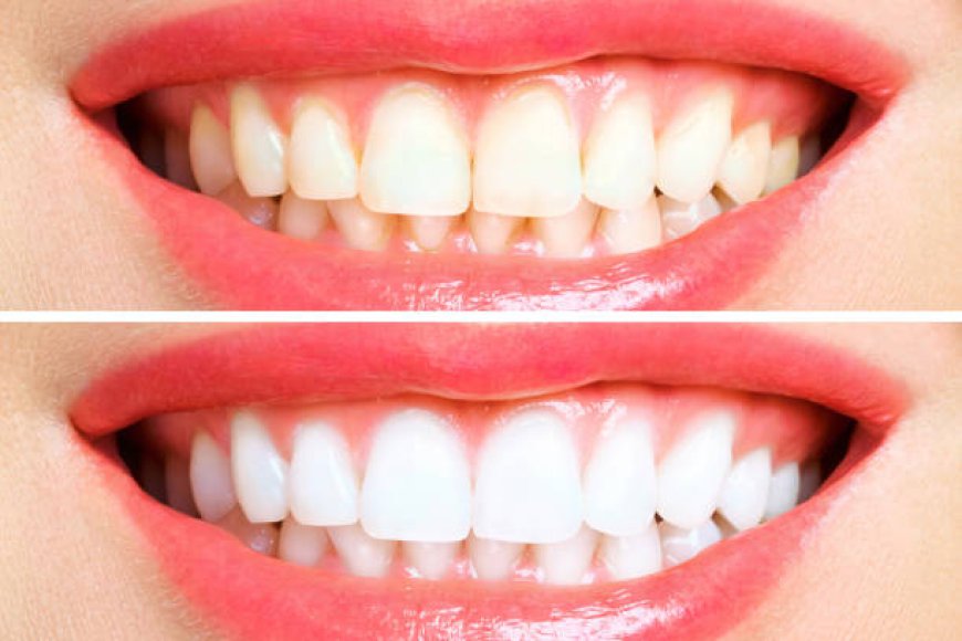 Crafting the Perfect Smile: Inside Hollywood Smile Design