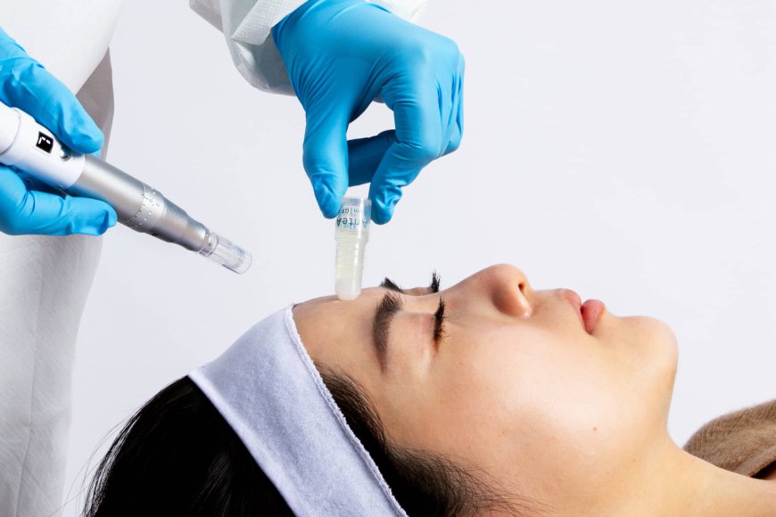 Get Radiant Skin with the Microneedling Technique