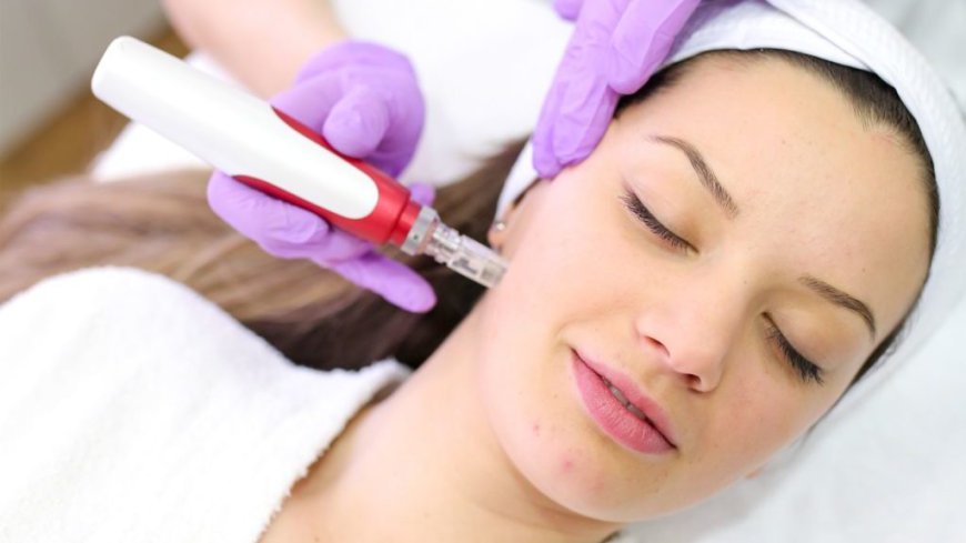 Rediscover Youthful Skin Through Microneedling