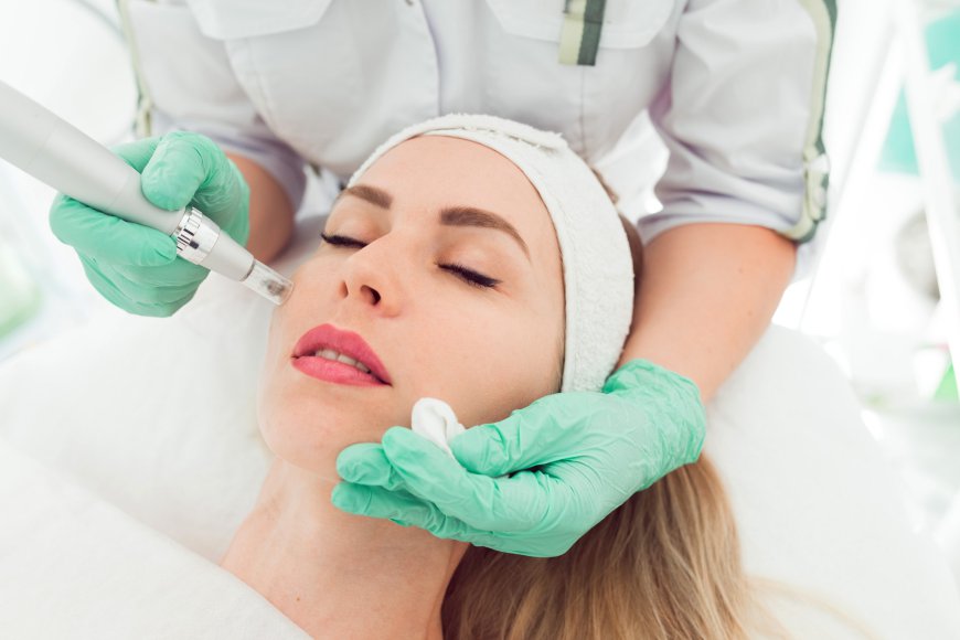 Microneedling: Your Key to Flawless Complexion