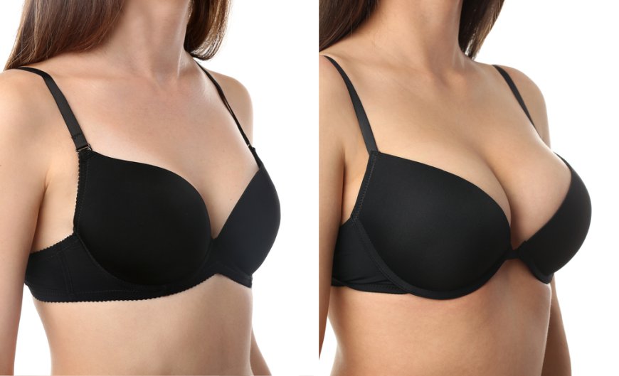 Comprehensive Guide to Breast Augmentation in Salt Lake City: Understanding Your Options for Breast Implants