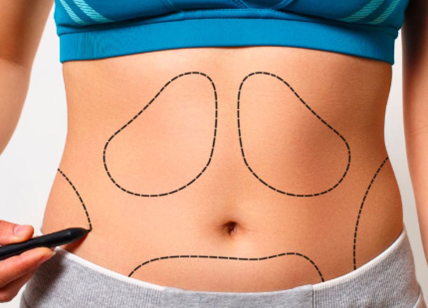 "Get the Best Deal: Understanding Liposuction Costs in Riyadh"