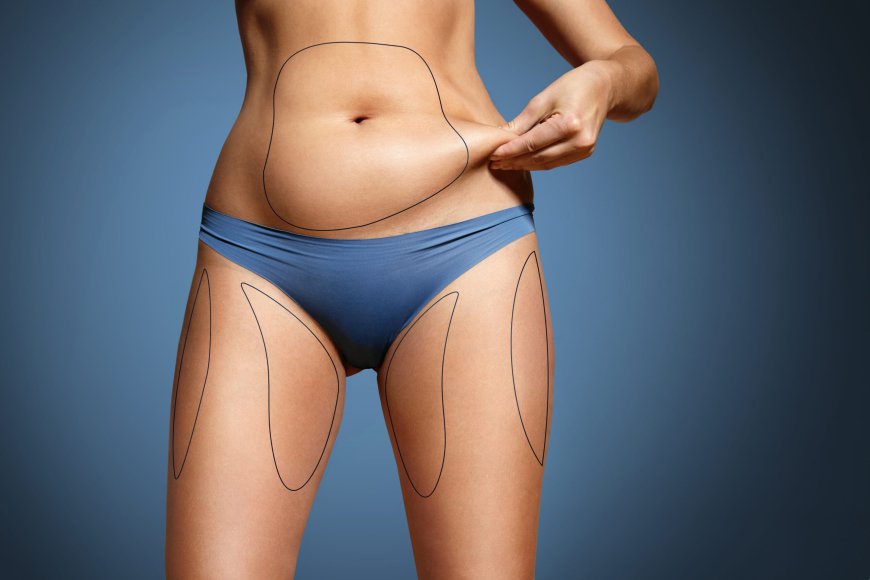 The Cost of Body Liposuction in Riyadh: Tips for Affordable Procedures