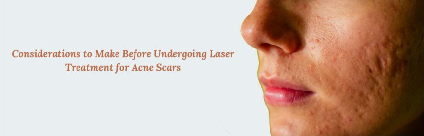 Considerations to Make Before Undergoing Laser Treatment for Acne Scars