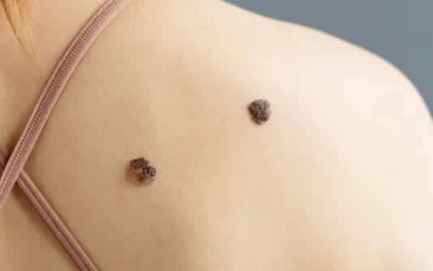 Clear Skin Awaits: The Most Effective Skin Tag Removal Treatments