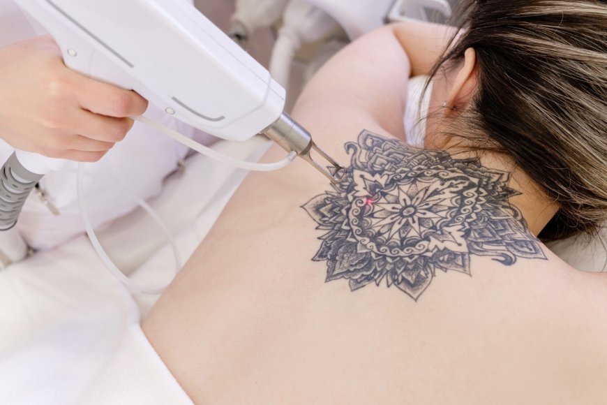 Transform Your Look with Laser Tattoo Removal