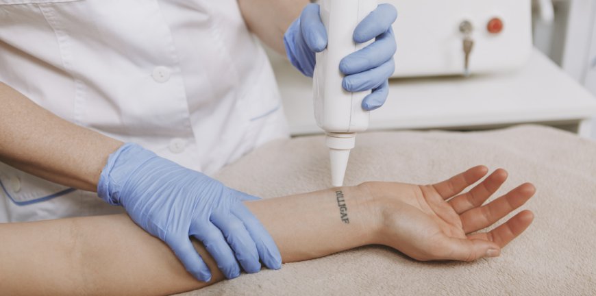 Best Laser Tattoo Removal for All Skin Types