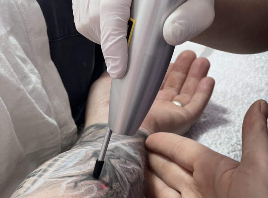 Discover Affordable Laser Tattoo Removal Today