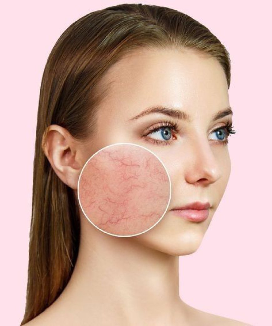 Rosacea: Understanding Triggers & Avoiding Irritants