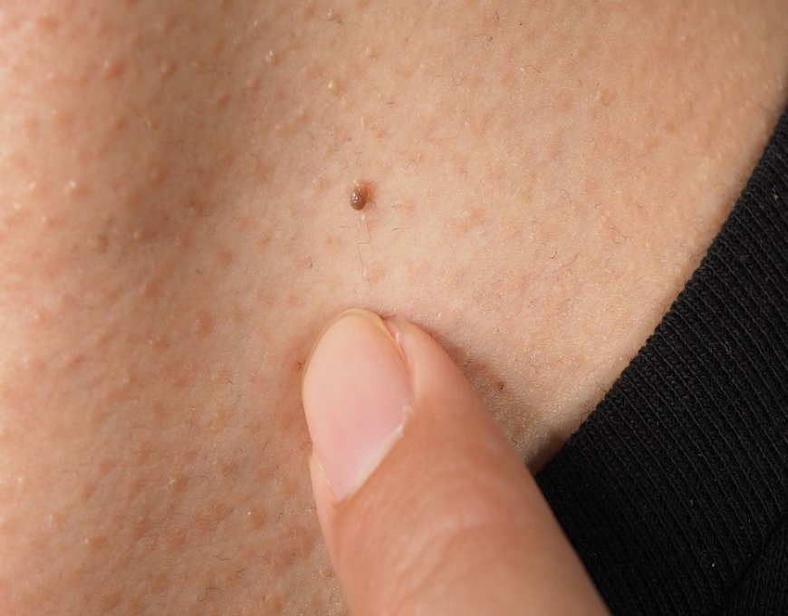 The Ultimate Guide to Skin Tag Removal in Dubai: What You Need to Know