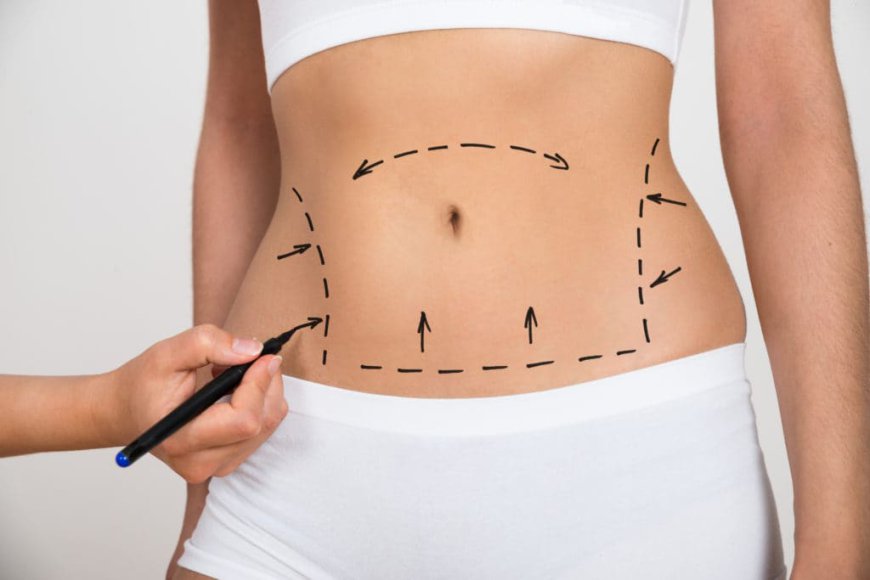 10 Steps to a Successful Tummy Tuck in Dubai