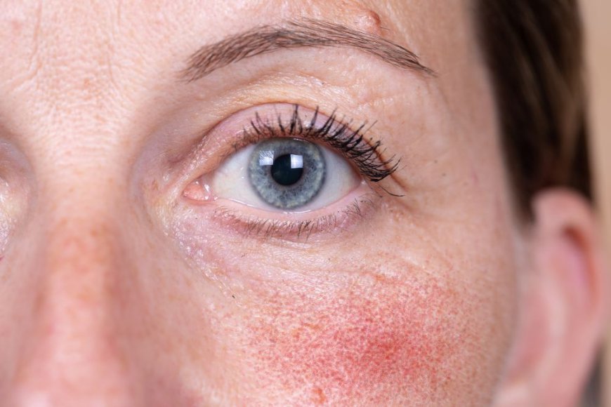 Rosacea: What Lies Beneath the Redness? Causes and Treatment Insights