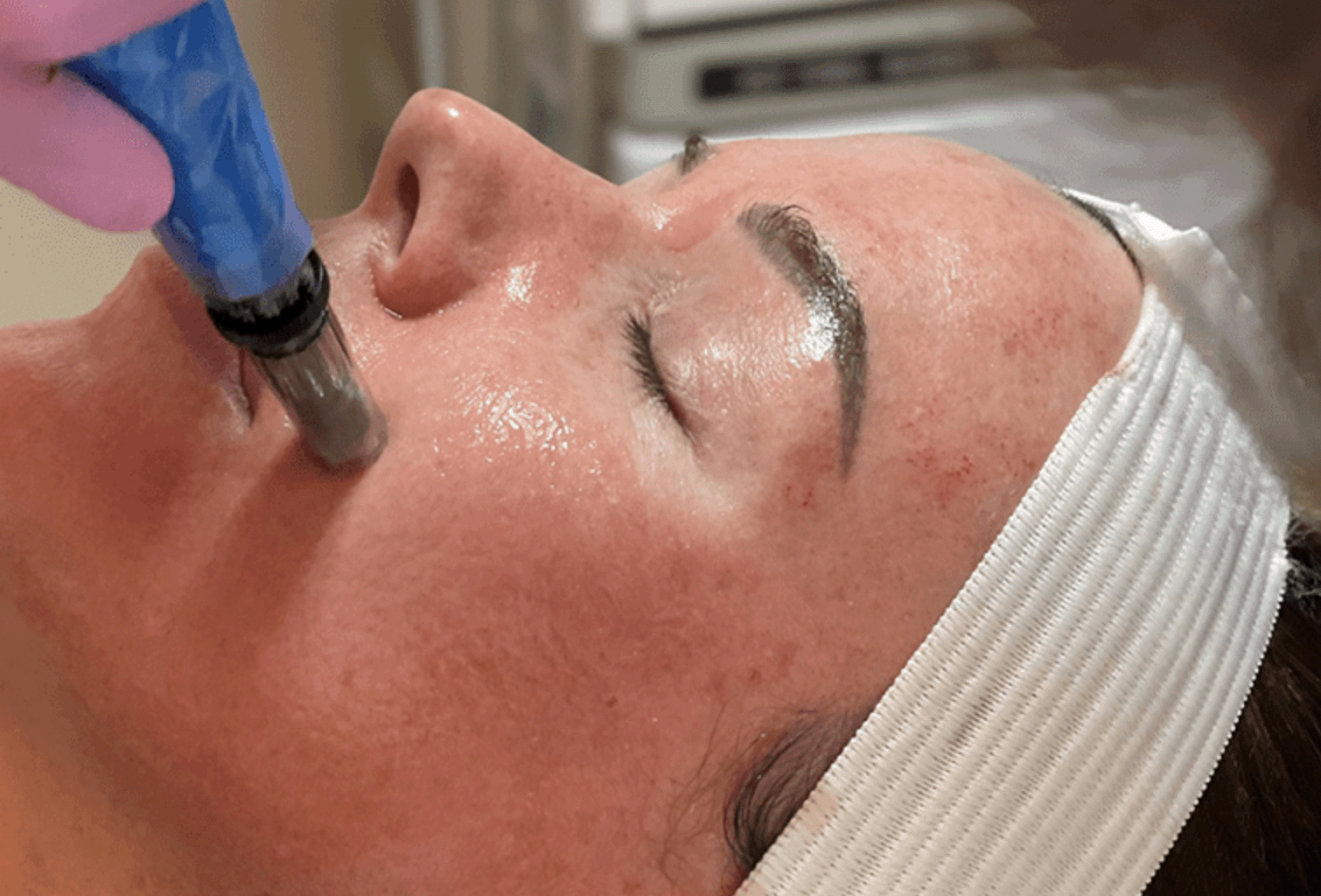 Revitalize and Renew Your Skin with Microneedling