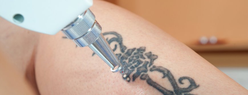 No More Regrets with Laser Tattoo Removal Options