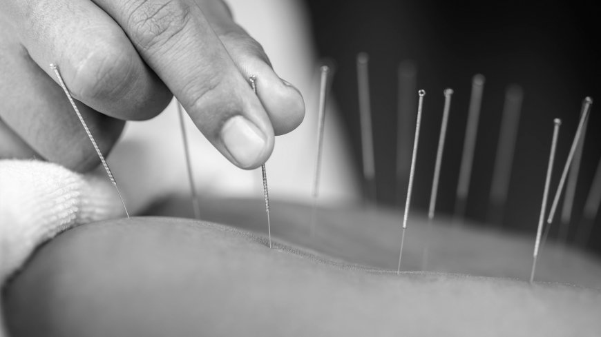 Acupuncture for Pain Management: What You Need to Know