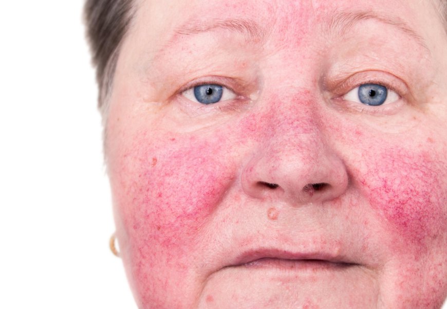 The Future of Rosacea Treatment: Emerging Therapies