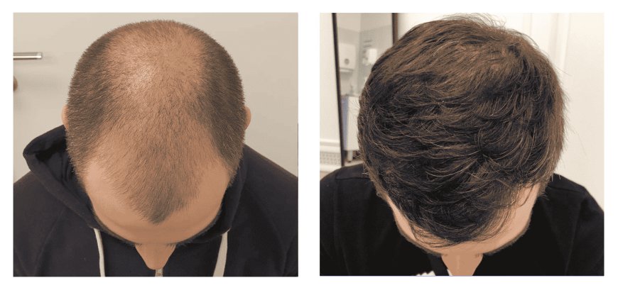 Cost Comparison: Hair Transplant Clinics in Dubai