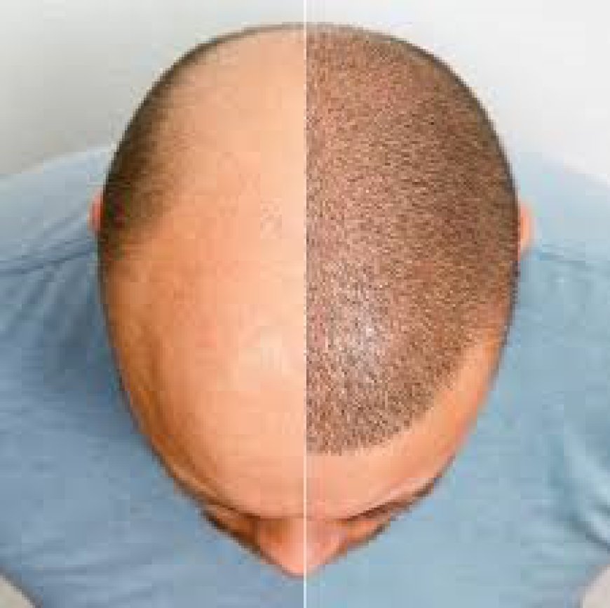 The Ultimate Guide to Hair Transplant Costs in Riyadh