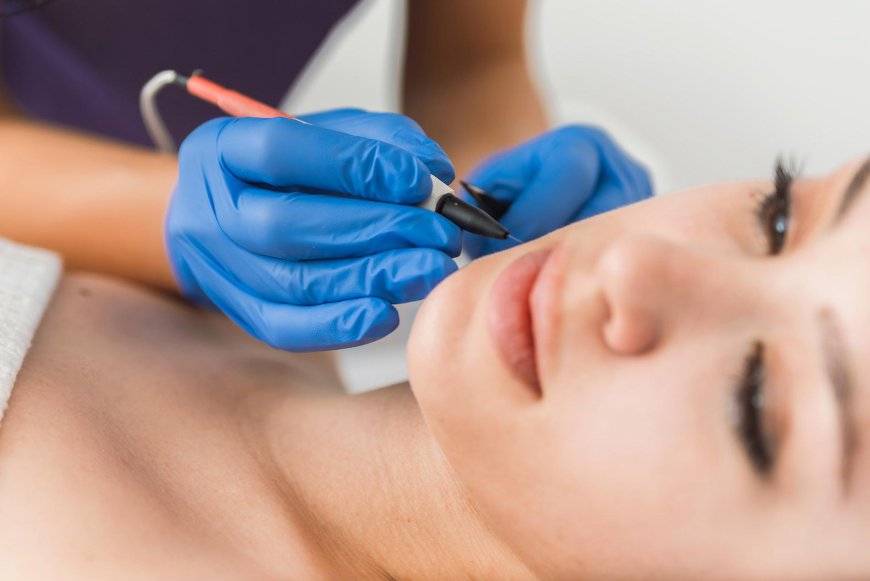 Electrolysis Hair Removal : What to Expect During Treatment