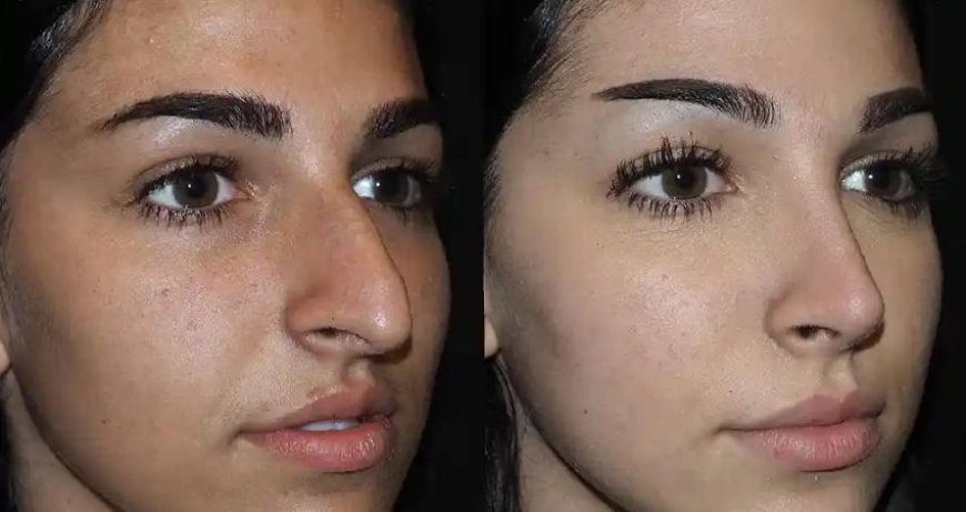 Discover the Best Rhinoplasty Surgeons in Dubai Today!