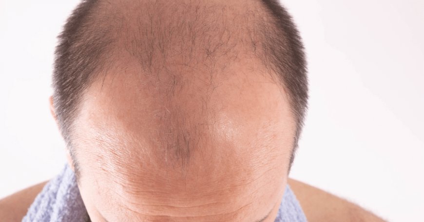 Finasteride for Hair Loss Discover the Benefits