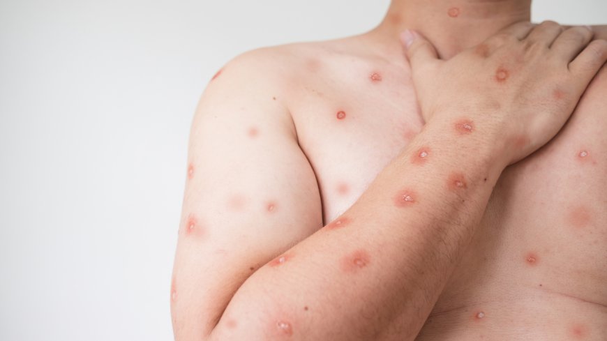 Understanding Monkeypox Virus Symptoms and Prevention