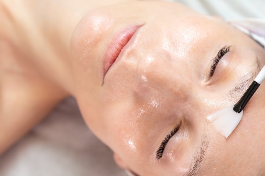 Revive and Renew: Benefits of Chemical Peels