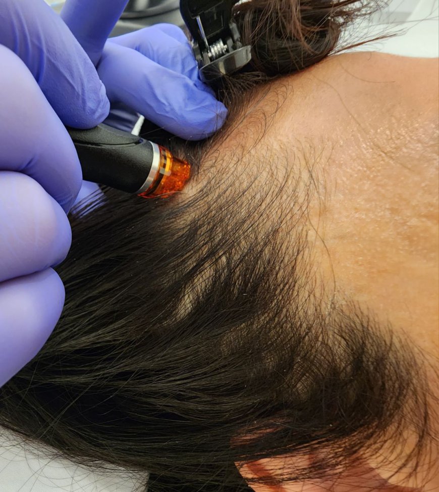 Hydrafacial Scalp Treatment: For All Hair Types