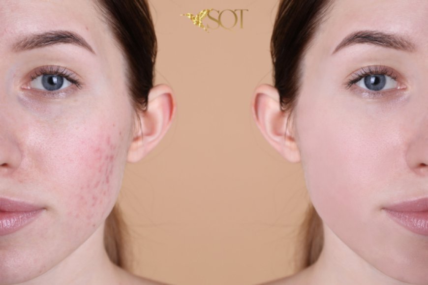 What to Expect Before and After SQT Bio Microneedling