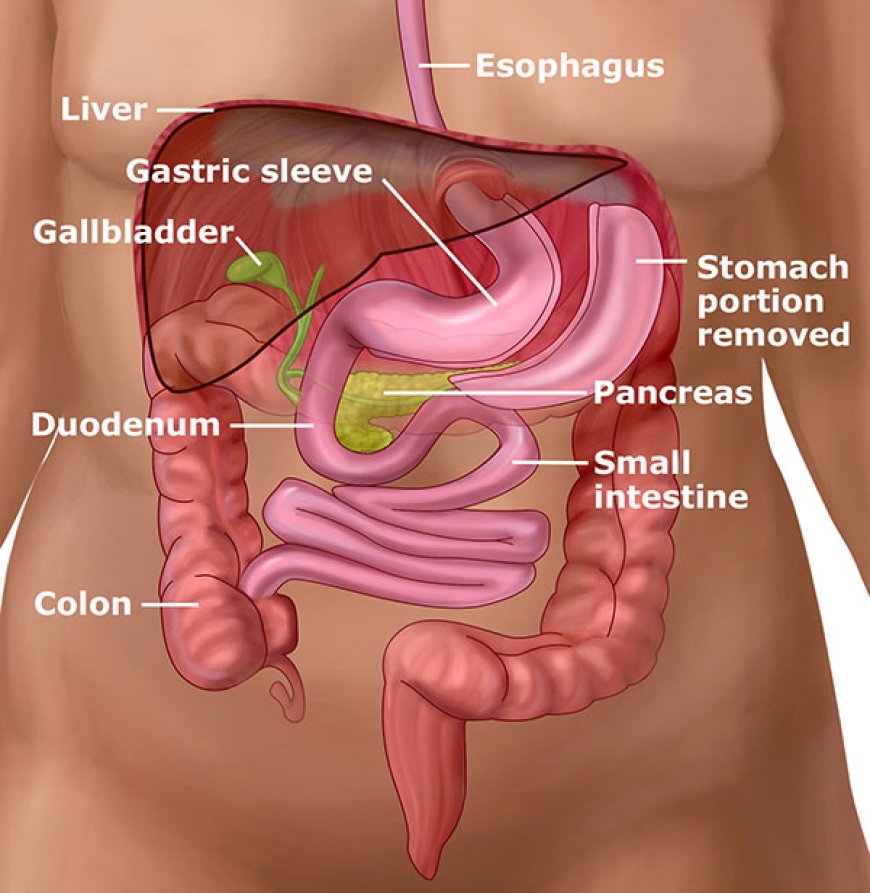 Laparoscopic Gastric Sleeve Surgery in Riyadh: A Cost vs. Benefit Analysis