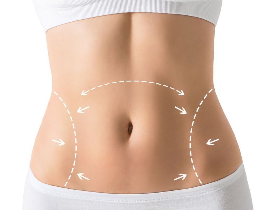 Tummy Tuck Recovery in Dubai: Tips and Tricks for a Smooth Healing Process