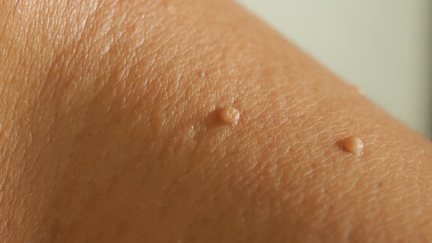 The Cost of Skin Tag Removal in Dubai: What to Expect