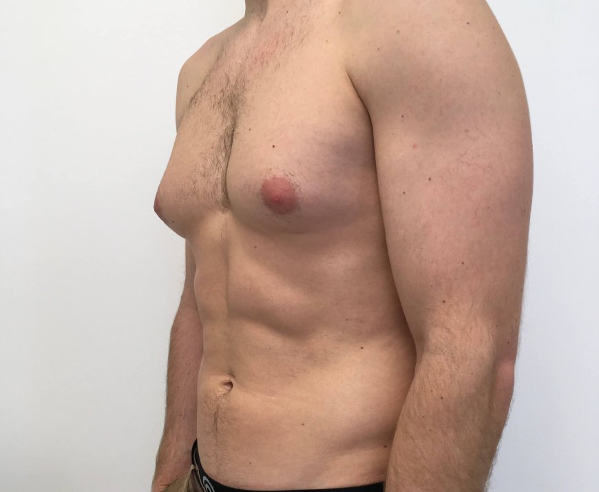 Gynecomastia Treatment: A Solution for Men with Enlarged Breasts