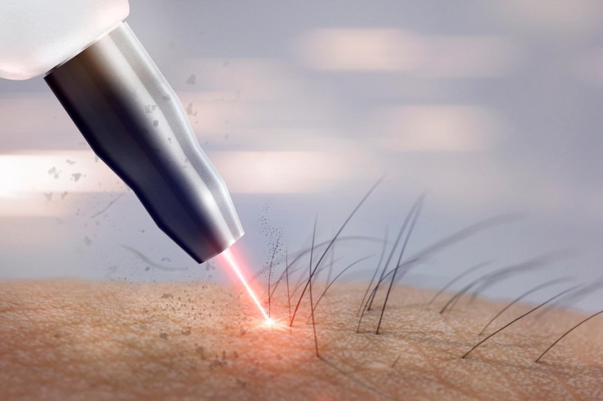 Aesthetic Laser Market Size, Share, Growth, Trends and Forecast