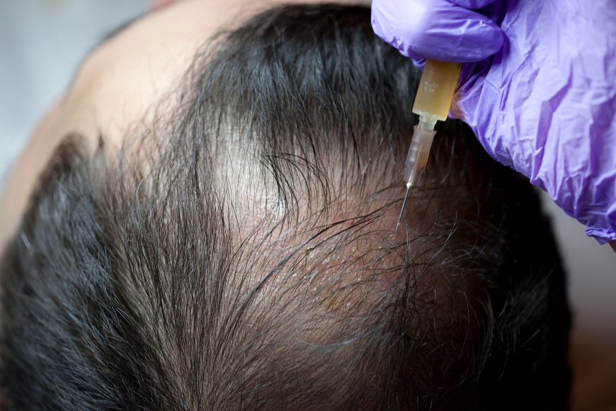 PRP Hair Therapy: What to Know Before Getting Started