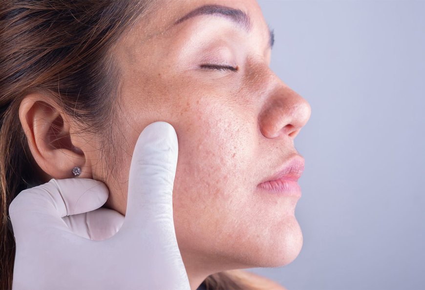 Skin Tags Removal by the Best Dermatologist in Dubai