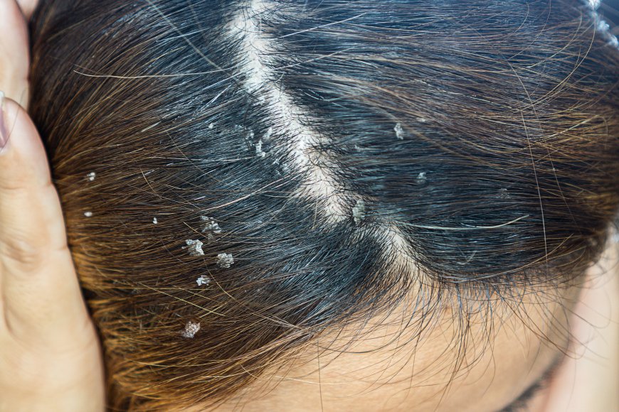 Hydrafacial Scalp Treatment: For Hair You’ll Love