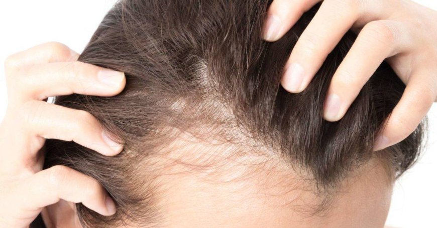 Combat Baldness with Finasteride for Hair Loss