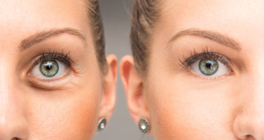 Eyelid Surgery in Riyadh: Discover the Latest Techniques and Trends