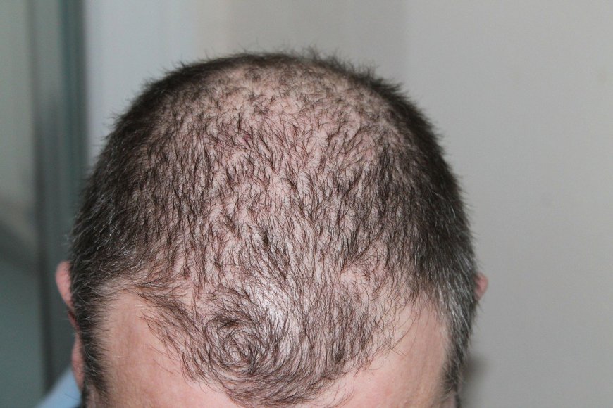 Finasteride for Hair Loss Get Real Hair Again