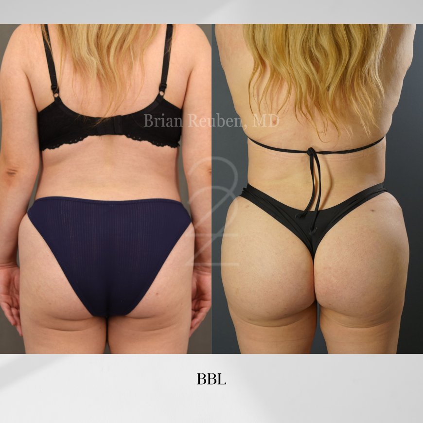 Transform Your Figure with Brazilian Butt Lift Surgery: Exploring the Benefits of BBL in Utah