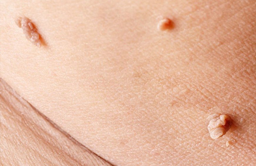 Treating Multiple Skin Tags with a Single Procedure