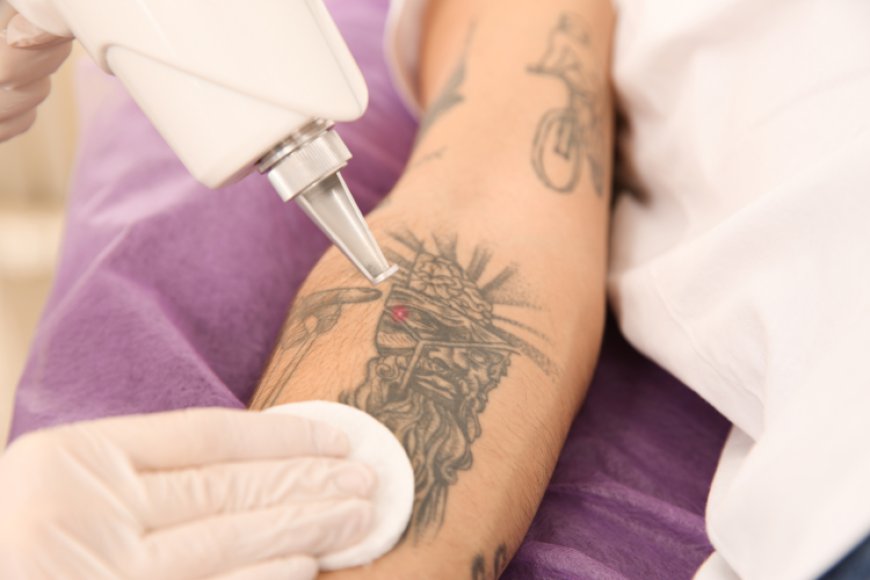 Laser Tattoo Removal for Cover-Up Tattoos: What to Consider