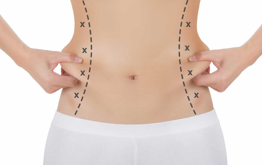 Top Considerations for Liposuction Surgery in UAE