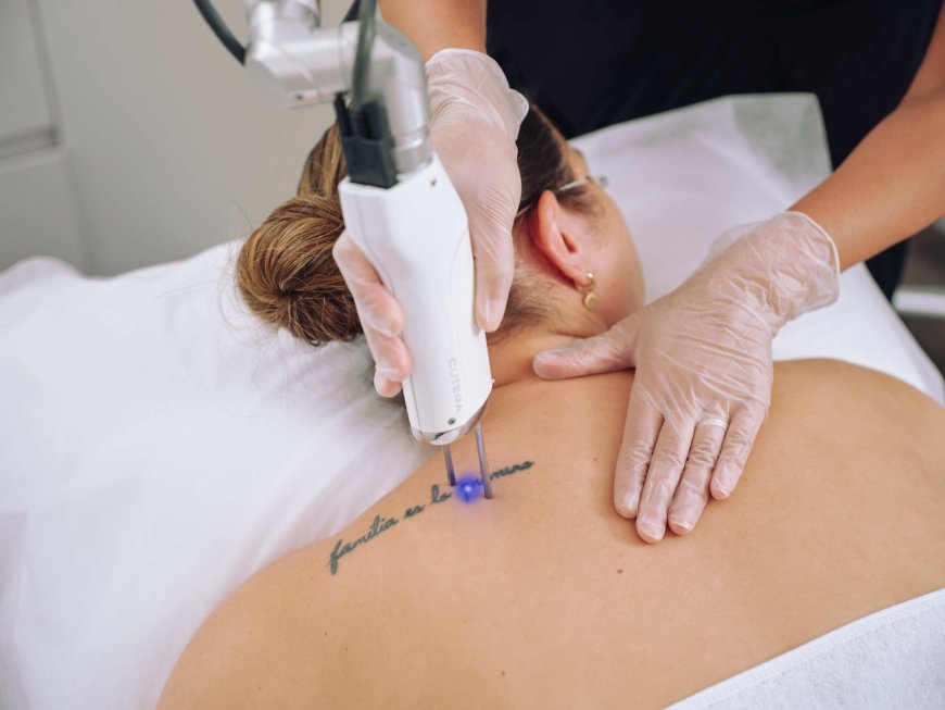 Long-Term Effects of Laser Tattoo Removal on Your Skin