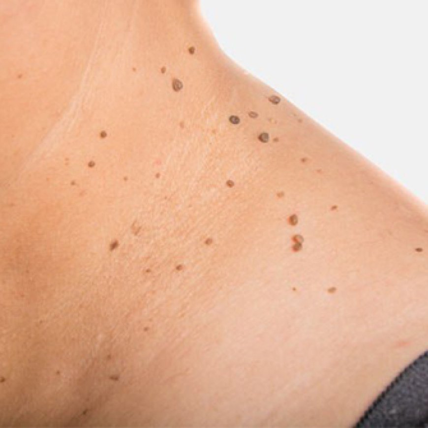 A Guide to Safe Skin Tag Removal Practices