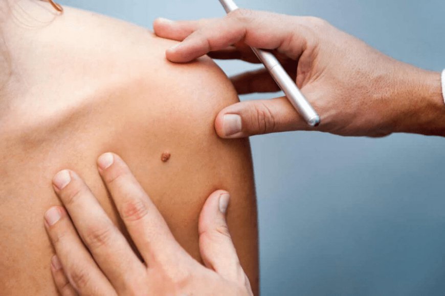 Skin Tag Removal: Tips for a Smooth Experience