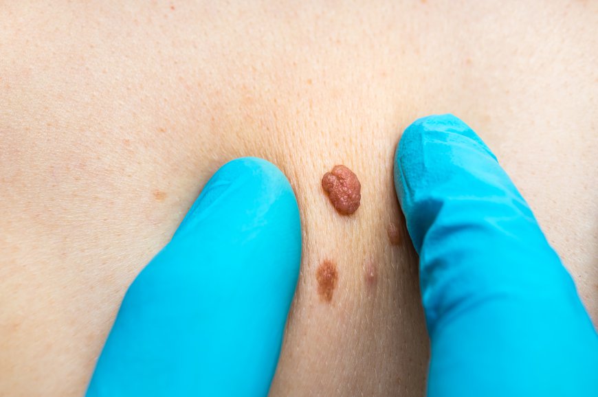 Skin Tag Removal: Best Practices for Healthy Skin